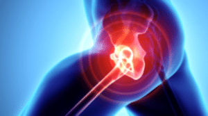Benefits-of-CBD-for-Hip-Bursitis-wallpaper - Stüdyo Pilates - Stüdyo Pilates